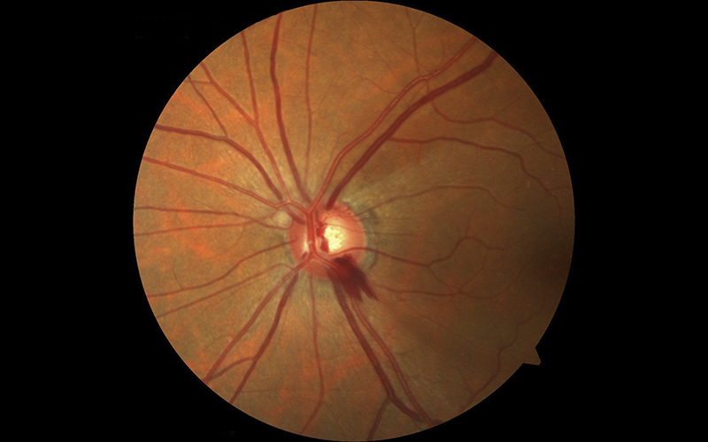 Glaucoma de Ángulo Abierto - Instituto de Oftalmología y Glaucoma Vasquez